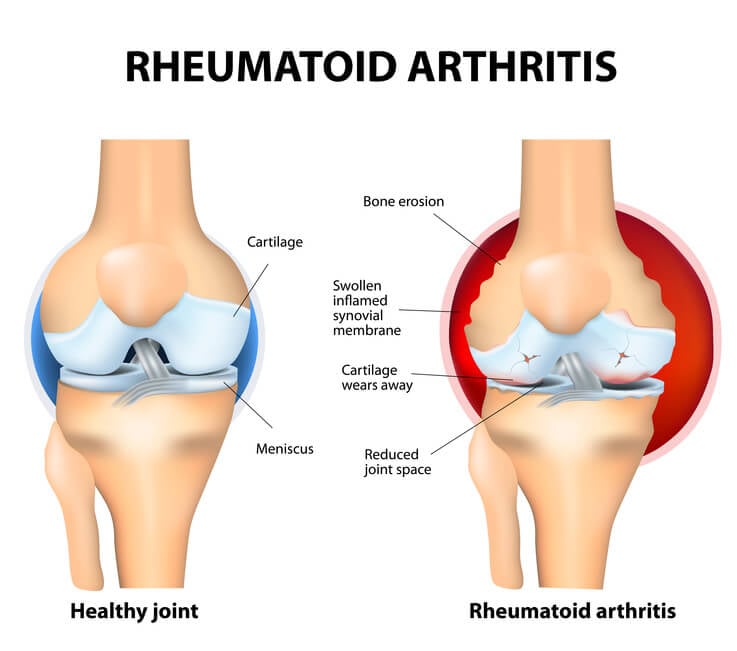 Rheumatoid Arthritis Foundation, Help Fight RA